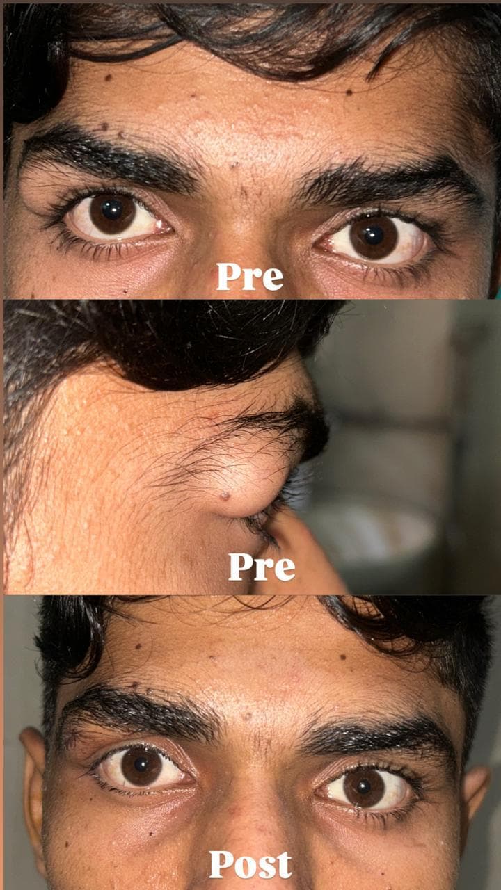 Delicate Oculoplastic Reconstruction Outcomes